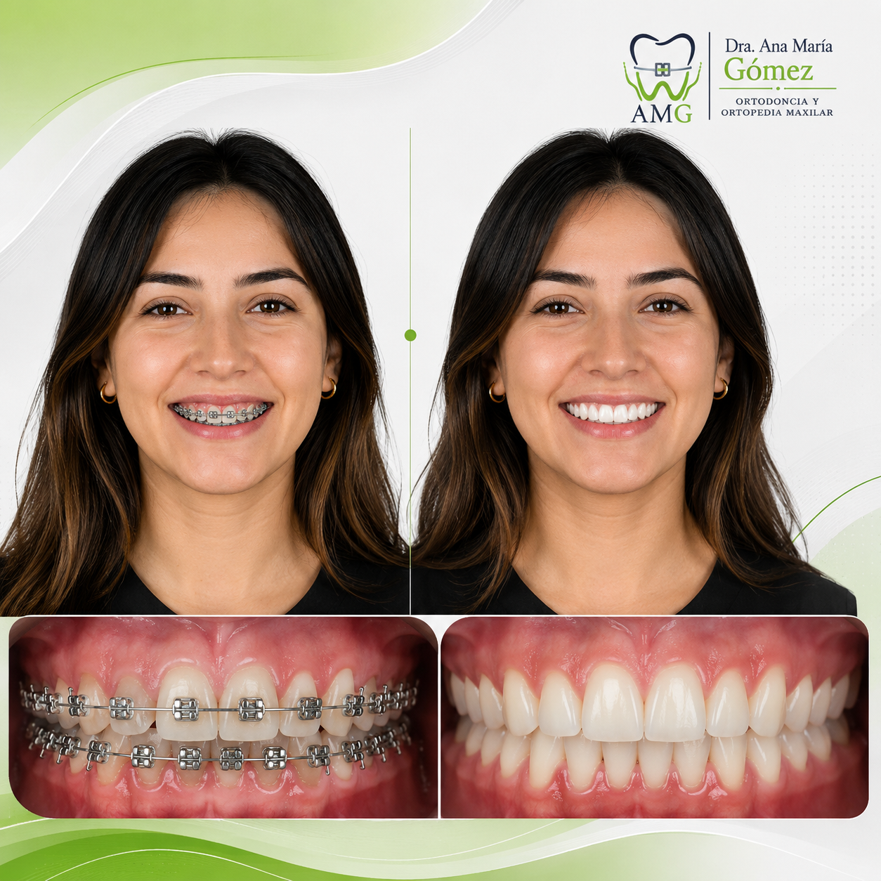 Caso clínico brackets